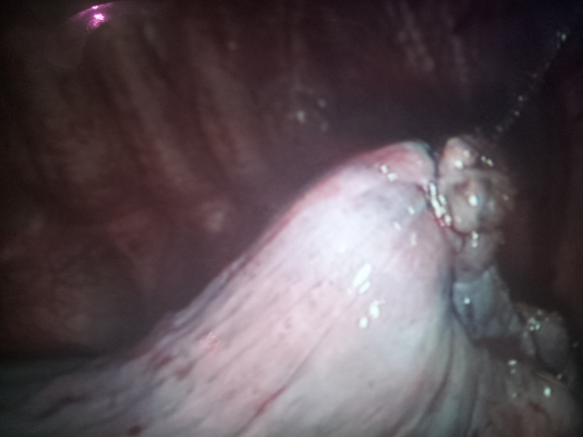 suturing of lung margin after bullectomy