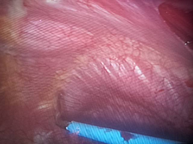 Dr Avinash Dal performs electrical pleurodesis