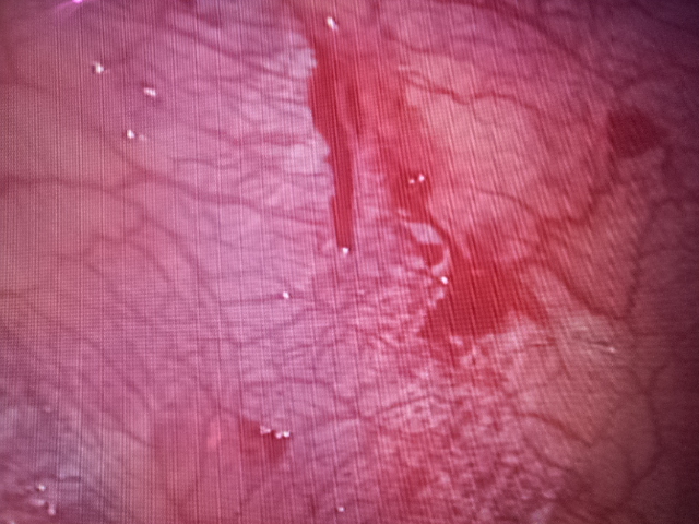 Pleurodesis by mechanical abrasion