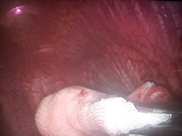 Mechanical abrasion by Dr Avinash Dal for pleurodesis