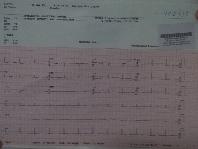 successful atrial fibrillation by Dr Avinash Dal