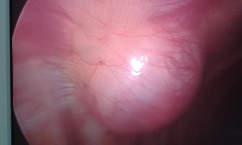 intrathoracic neruofibroma (by Dr Avinash Dal)