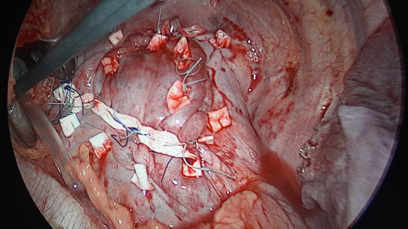 diaphragmatic plication Dr Avinash Dal