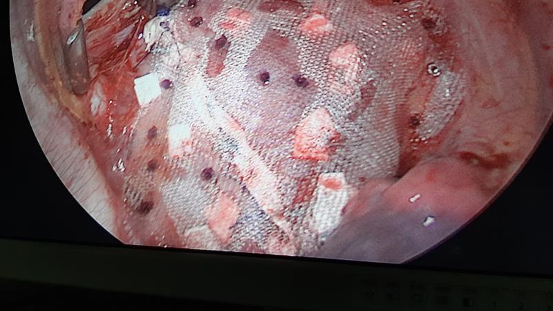 Polypropylene mesh repair after plication Dr Avinash Dal