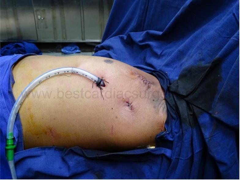 Final incisions in VATS surgery