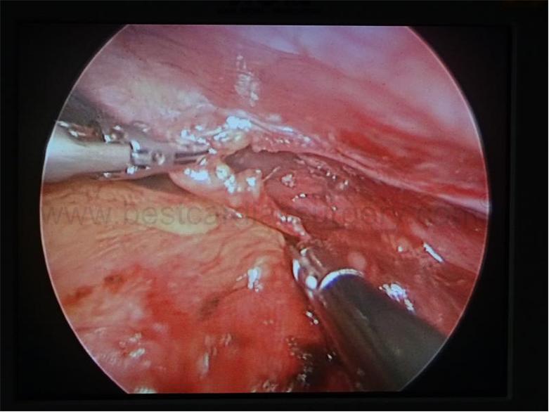 Dr Avinash Dal doing endothoracic dissection