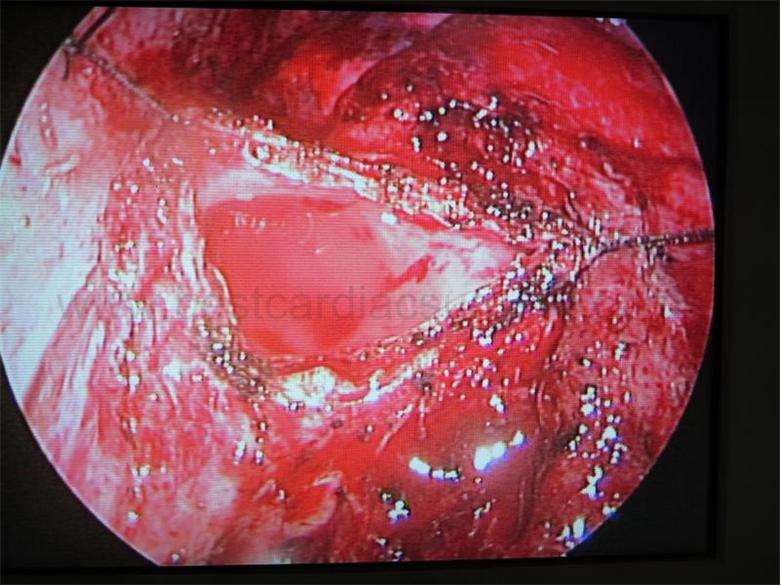 VATS excision for bronchogenic cyst, Dr Avinash Dal