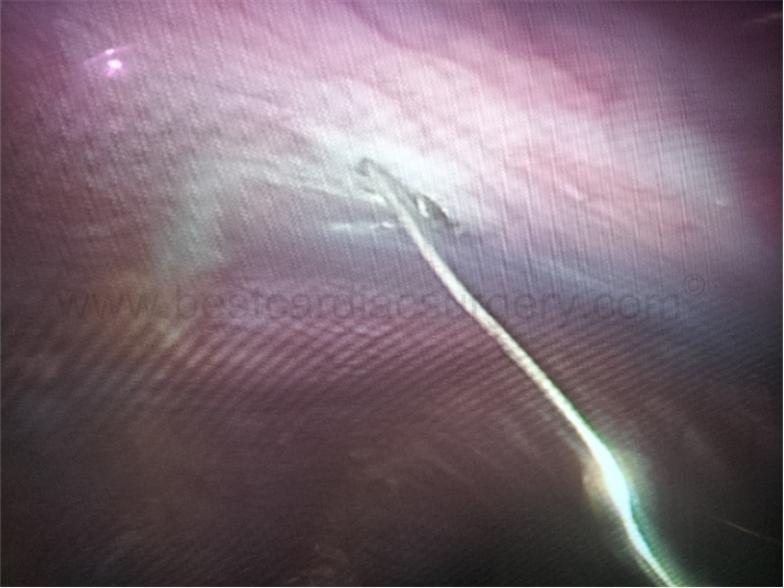 pleurodesis with cautery