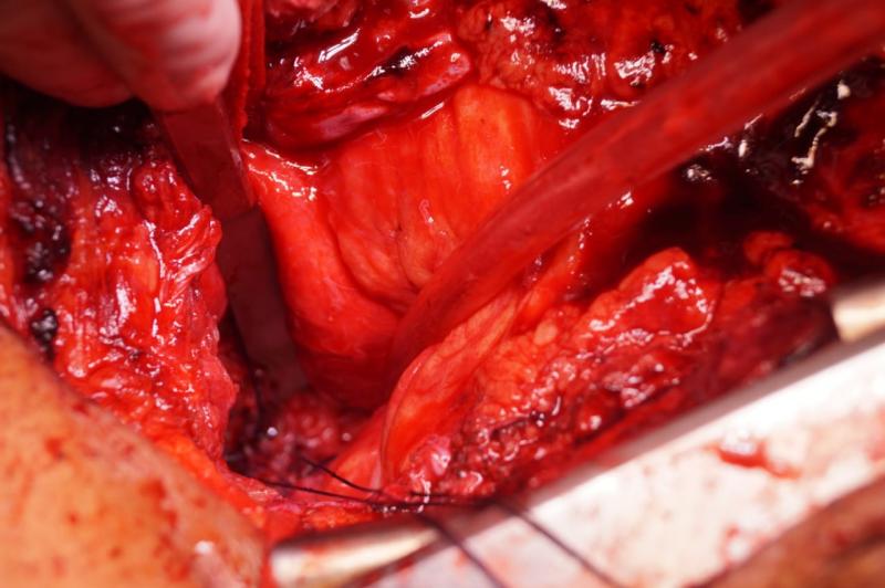 Dr Avinash Dal approaching the right main bronchus between aorta & SVC