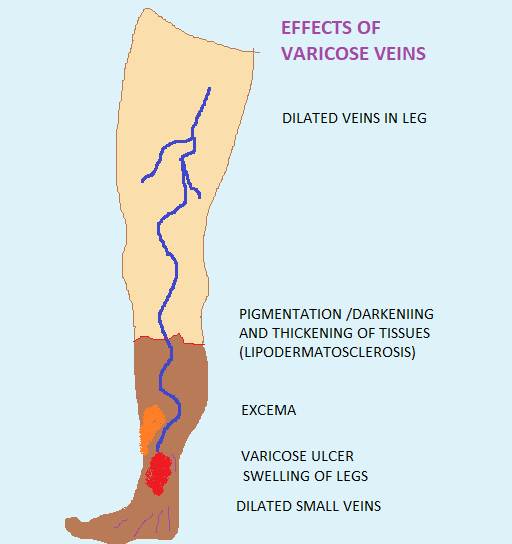 Effects of Varicose veins bestcardiacsurgery.com