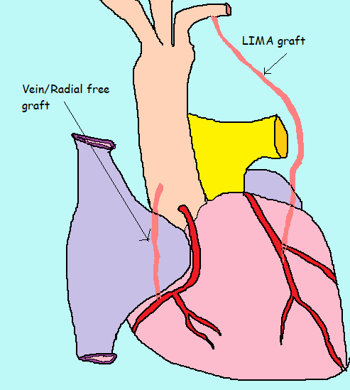 CABG diagram for bestcardiacsurgery.com