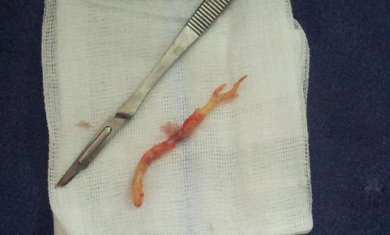 Atheroma removed from coronary artery by off-pump technique