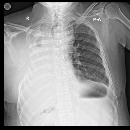 Dr Avinash Dal successful TSTP BPF closure xray