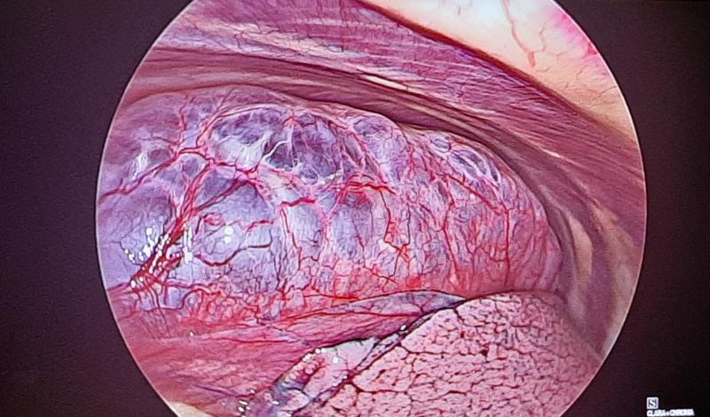 Lung Bulla Dr Avinash Dal case Virinchi Hospitals