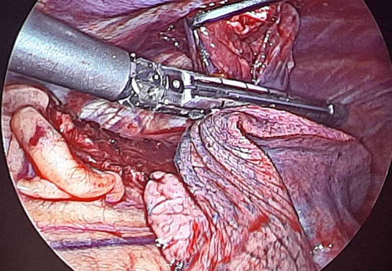 Dr Avinash Dal VATS lung staple applied (thoracoscopy)