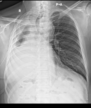 pre-operative xray residual pleural space