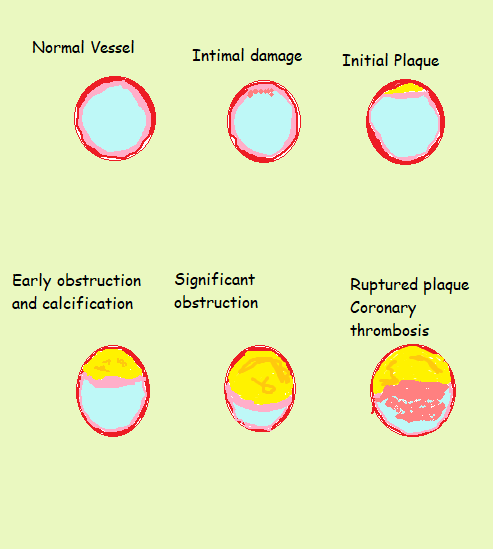 stages of coronary blocks Dr Avinash Dal