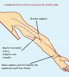 VASCULAR SURGERY-AV Fistula-common sites
