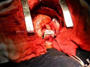 Heart Valve Replacement & repair- Bentall de Bono Procedure by Dr Avinash Dal