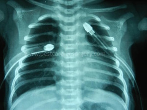 Pediatric Lung Surgery, Bilateral Neonatal Pneumothorax - by Dr Avinash Dal
