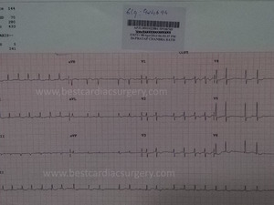 Heart Valve Replacement & Repair- pre-operative ECG by Dr Avinash Dal