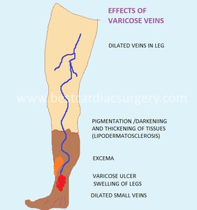 Varicose Veins Surgery- Effects of Varicose Veins by Dr Avinash Dal