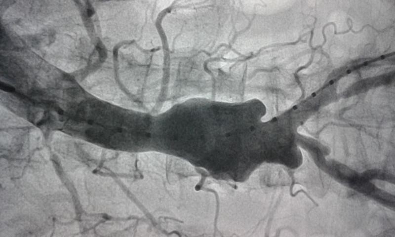 Vascular Surgery- Endovascular Aortic Repair- EVAR by Dr Avinash Dal