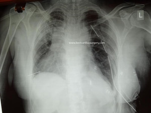 VATS-Thoracic Surgery Eventration of Diaphragm