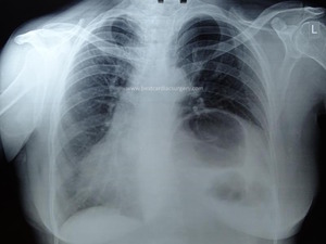 VATS-Thoracic Surgery-Eventration of Diaphragm