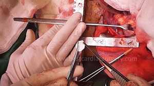 Pediatric Heart Surgery- Fontan Surgery by Dr Avinash Dal