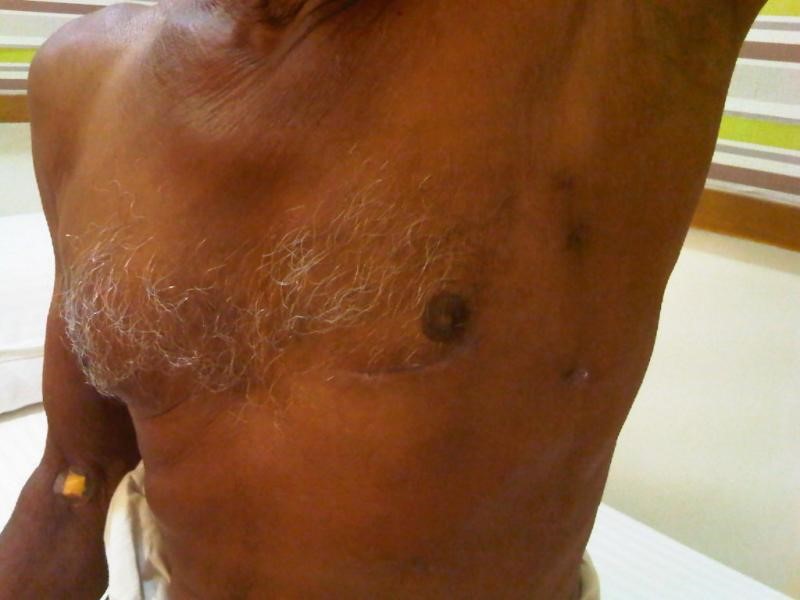 Minimal Access Cardiac Surgery MICS small scar