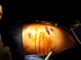 Minimal Access Cardiac Surgery MICS-CAB incision