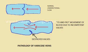 Varicose Veins Surgery- Pathology of Varicose Veins by Dr Avinash Dal