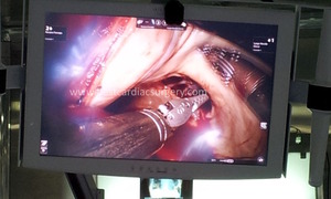 Robotic Cardiac Surgery- procedure by Dr Avinash Dal