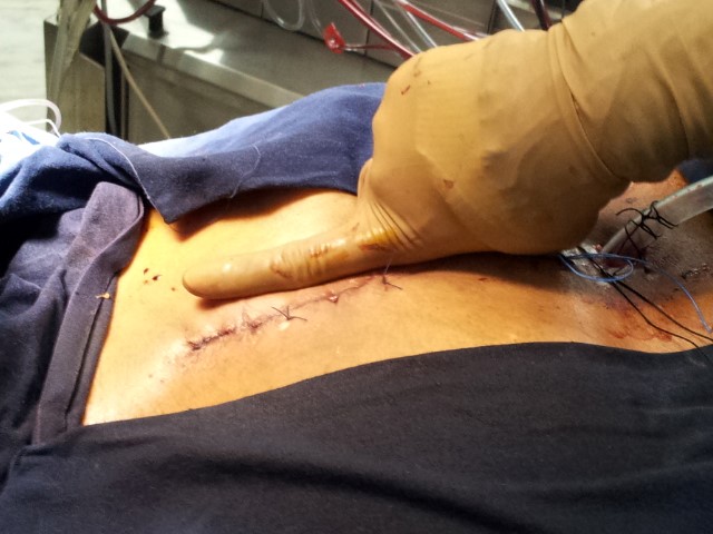 Minimal Access Cardiac Surgery MICS Procedure