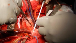 Heart Valve Replacement & Repair- Surgical Ablation Atrial Fibrillation by Dr Avinash Dal