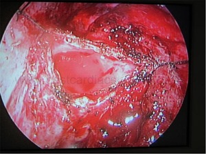 VATS-Thoracic Surgery-Thymectomy