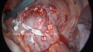 VATS-Thoracic Surgery- Bronchogenic Cyst