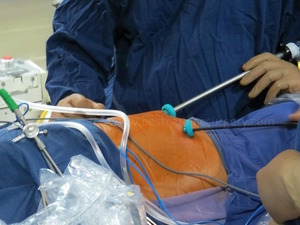 VATS-Thoracoscopic Surgery-Technique by Dr Avinash Dal