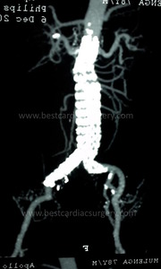 VASULAR SURGERY EVAR-endovascular repair aortic aneurysm by Dr Avinash Dal