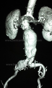 VASCULAR SURGERY- EVAR-endovascular repair aortic aneurysm by Dr Avinash Dal