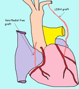 Coronary Artery Bypass Surgery
