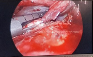 VATS-Thoracic Surgery- Lingular Lobectomy by Dr Avinash Dal