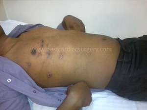 Robotic Cardiac Surgery by Dr Avinash Dal- minimal skin scars