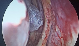 VATS-Thoracic Surgery-bullectomy by Dr Avinash Dal