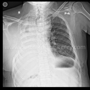 VATS-Thoracic Surgery-Bronchopleural Fistula by Dr Avinash Dal