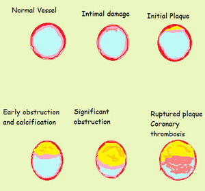 Coronary Artery Bypass Surgery (CABG)