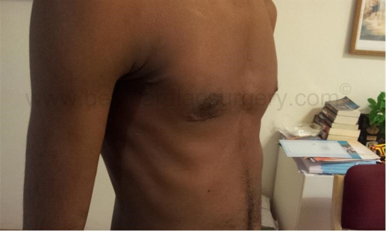 Minimal Access Cardiac Surgery MICS scar