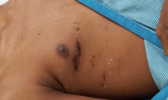 Minimal Invasive Cardiac Surgery MICS small scar