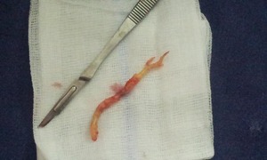 CORONARY ARTERY BYPASS SURGERY (CABG)